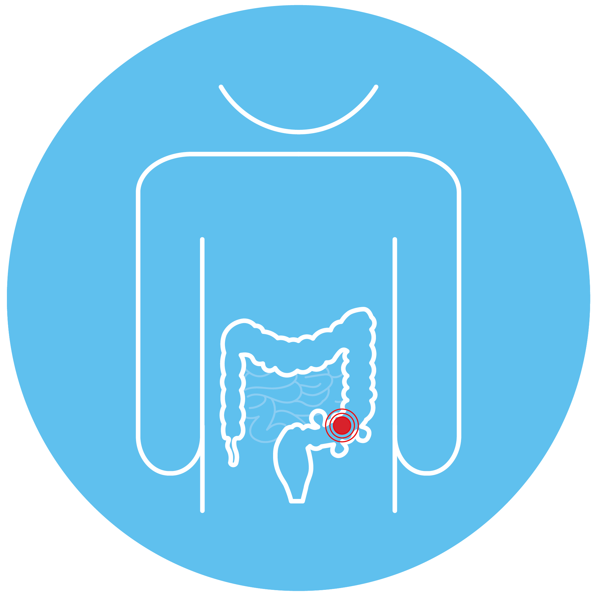 Diverticulitis